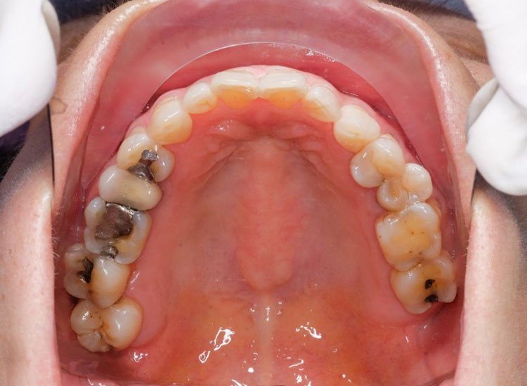 Leaking Amalgam Filling? Why the Cost to Have It Replaced Might be ...