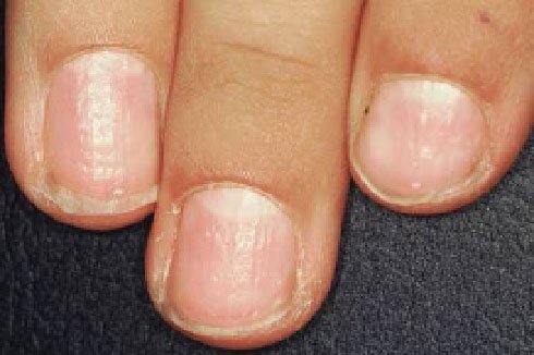 What Do Yellow Fingernails (With or Without Lifting + Pitting) Mean? -  Organic Olivia » Organic Olivia