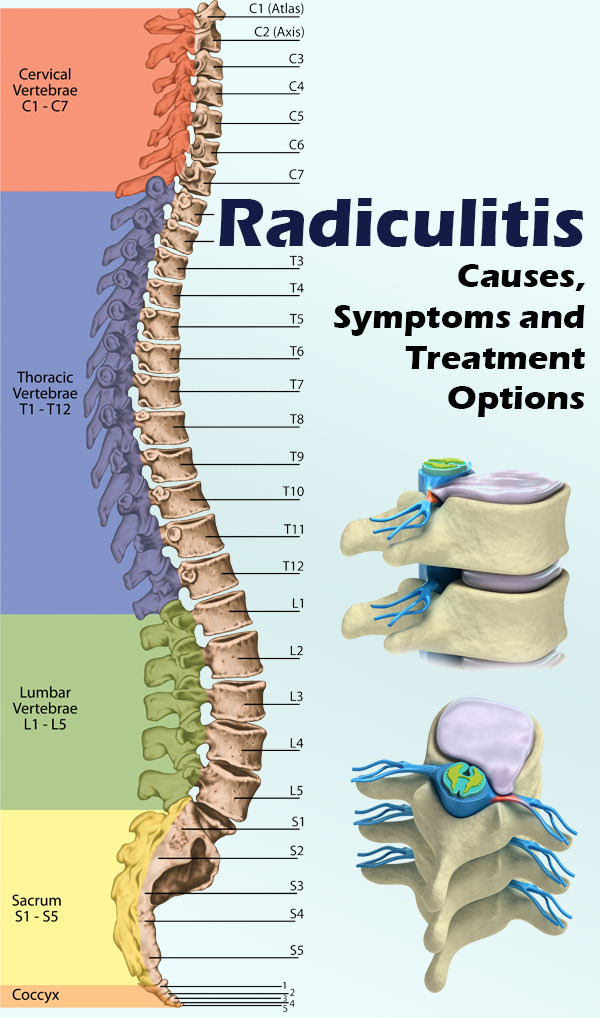 Radiculitis – Causes, Symptoms and Treatment Options - The Health ...