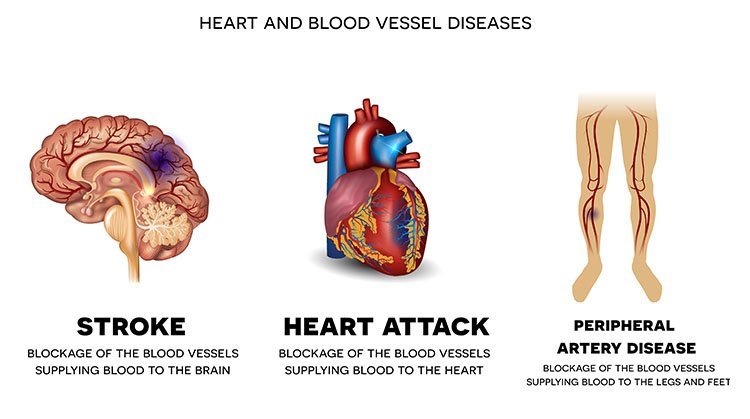 What Is Heart Blood Vessel Disease