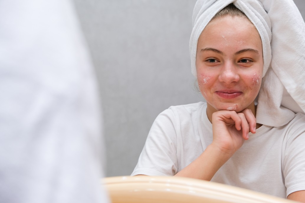 a-smiling-teenage-girl-who-smeared-pimples-on-her-face-with-a-medicinal-cream-acne-treatment